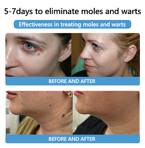 Acne Drying Lotion – Fights Inflamed & Pus-Filled Pimples Fast