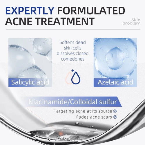 Acne Drying Lotion – Fights Inflamed & Pus-Filled Pimples Fast